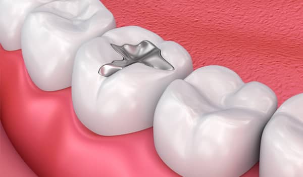 Treatment - Purlys Dental Practice