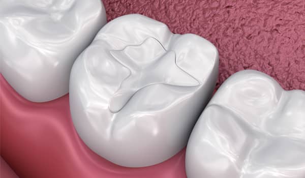 Treatment - Purlys Dental Practice
