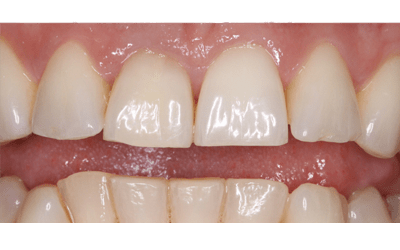 After - Purlys Dental Practice